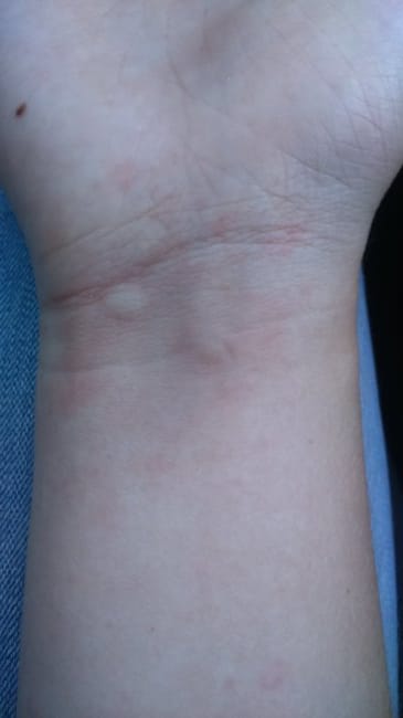 Foin avec des épines et allergies