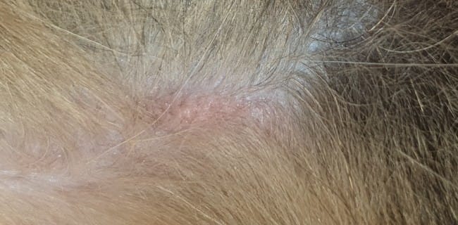 Boules étranges sous omoplate - photo