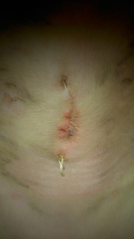 Que penser de cette cicatrice de stérilisation ?