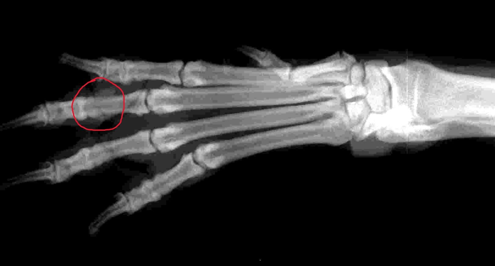 Fracture phalange passé quasiment inaperçu demande avis.